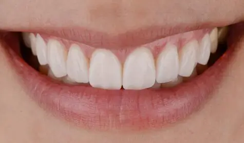 Smile Image