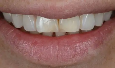Smile Image